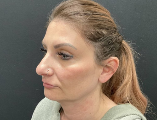 A woman in her early 40s shown 3.5 months after a chin implant, deep plane neck lift and jaw line liposuction