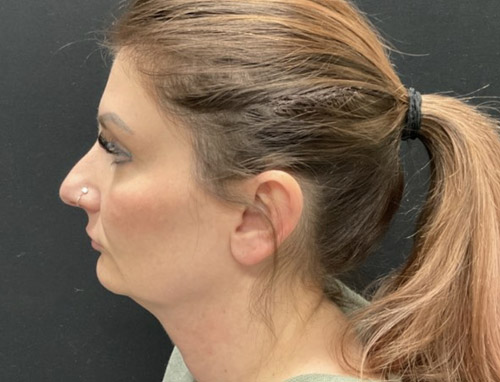 A woman in her early 40s shown 3.5 months after a chin implant, deep plane neck lift and jaw line liposuction