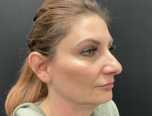 A woman in her early 40s shown 3.5 months after a chin implant, deep plane neck lift and jaw line liposuction