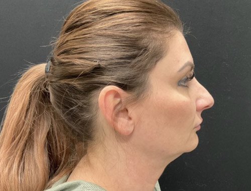 A woman in her early 40s shown 3.5 months after a chin implant, deep plane neck lift and jaw line liposuction