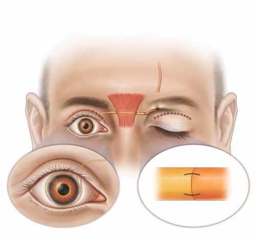 corneal neurotization performed