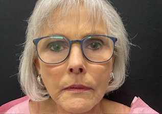 75 year old female shown 3 months after upper lip lift and placement of lip filler to improve peri oral lines