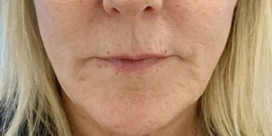 dermal fillers before patient 2