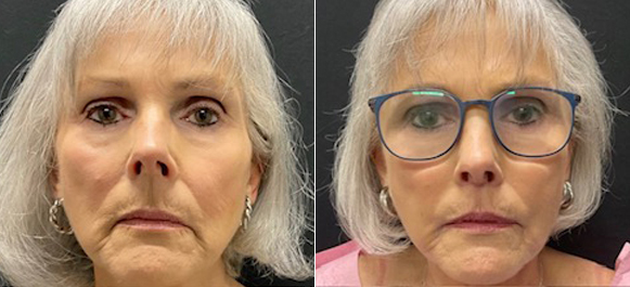 75 year old female shown 3 months after upper lip lift and placement of lip filler to improve peri oral lines