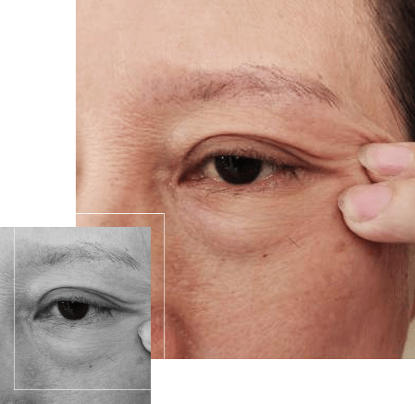 image of cellulite under the eyes of the woman