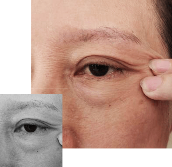 image of cellulite under the eyes of the woman image of cellulite under the eyes of the woman