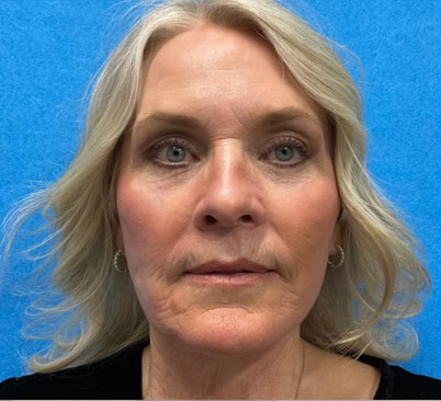 60 -year-old woman about 4 months after Endoscopic brow lift, upper and lower blepharoplasties with fat repositioning, upper lip lift, full face and neck lift, ear lobe reduction and Blue peel.