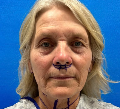 60 -year-old woman about 4 months after Endoscopic brow lift, upper and lower blepharoplasties with fat repositioning, upper lip lift, full face and neck lift, ear lobe reduction and Blue peel.
