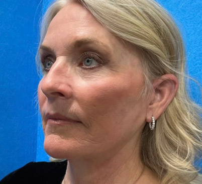 60 -year-old woman about 4 months after Endoscopic brow lift, upper and lower blepharoplasties with fat repositioning, upper lip lift, full face and neck lift, ear lobe reduction and Blue peel.