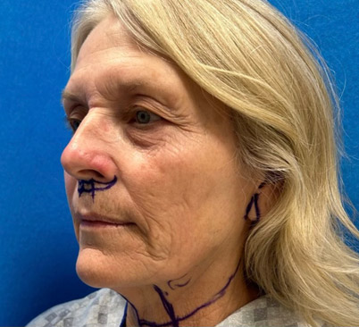 60 -year-old woman about 4 months after Endoscopic brow lift, upper and lower blepharoplasties with fat repositioning, upper lip lift, full face and neck lift, ear lobe reduction and Blue peel.