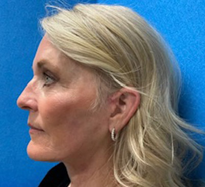 60 -year-old woman about 4 months after Endoscopic brow lift, upper and lower blepharoplasties with fat repositioning, upper lip lift, full face and neck lift, ear lobe reduction and Blue peel.