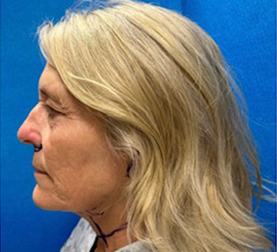 60 -year-old woman about 4 months after Endoscopic brow lift, upper and lower blepharoplasties with fat repositioning, upper lip lift, full face and neck lift, ear lobe reduction and Blue peel.