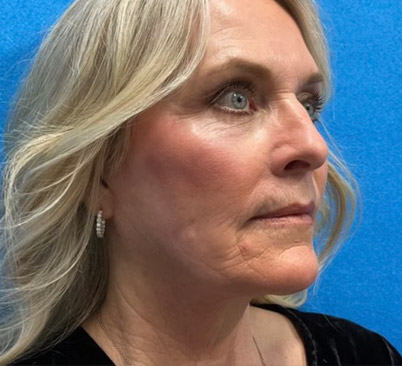 60 -year-old woman about 4 months after Endoscopic brow lift, upper and lower blepharoplasties with fat repositioning, upper lip lift, full face and neck lift, ear lobe reduction and Blue peel.