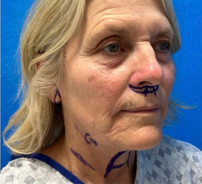 60 -year-old woman about 4 months after Endoscopic brow lift, upper and lower blepharoplasties with fat repositioning, upper lip lift, full face and neck lift, ear lobe reduction and Blue peel.