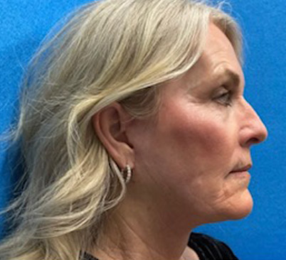 60 -year-old woman about 4 months after Endoscopic brow lift, upper and lower blepharoplasties with fat repositioning, upper lip lift, full face and neck lift, ear lobe reduction and Blue peel.