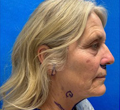 60 -year-old woman about 4 months after Endoscopic brow lift, upper and lower blepharoplasties with fat repositioning, upper lip lift, full face and neck lift, ear lobe reduction and Blue peel.