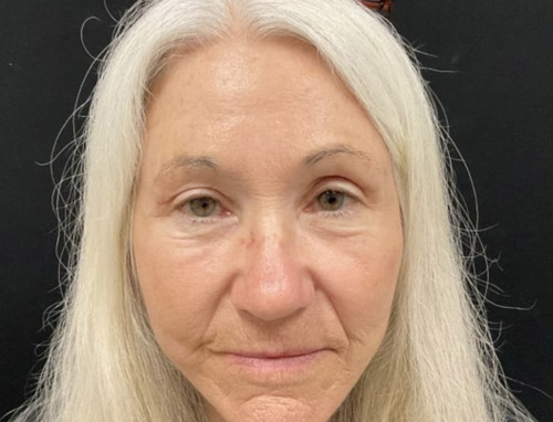 A woman in her late 60s shown about 3 months after a full face and neck lift, endoscopic brow lift and bilateral upper blepharoplasties.