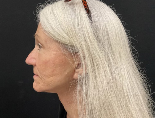 A woman in her late 60s shown about 3 months after a full face and neck lift, endoscopic brow lift and bilateral upper blepharoplasties.