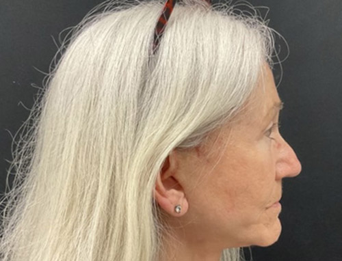 A woman in her late 60s shown about 3 months after a full face and neck lift, endoscopic brow lift and bilateral upper blepharoplasties.
