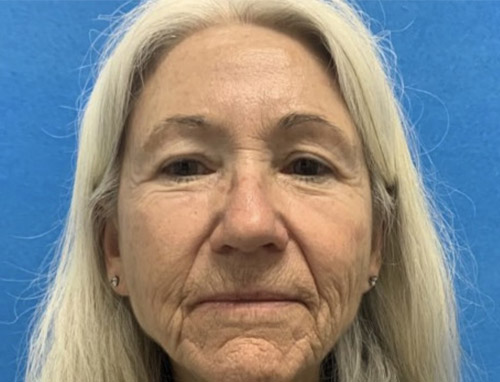 A woman in her late 60s shown about 3 months after a full face and neck lift, endoscopic brow lift and bilateral upper blepharoplasties.