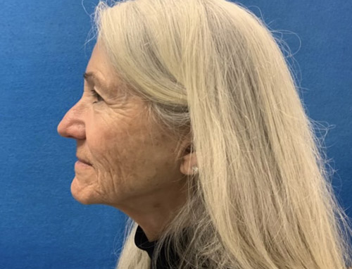 A woman in her late 60s shown about 3 months after a full face and neck lift, endoscopic brow lift and bilateral upper blepharoplasties.