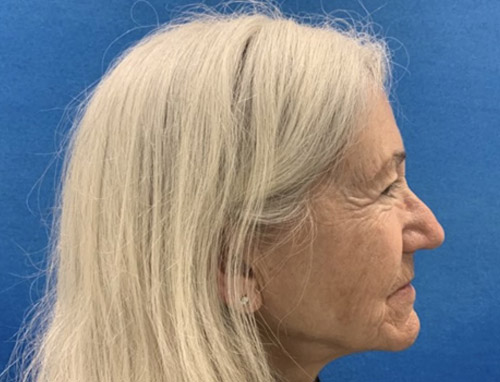 A woman in her late 60s shown about 3 months after a full face and neck lift, endoscopic brow lift and bilateral upper blepharoplasties.