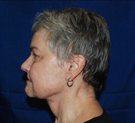 Shown above is a woman in her 60’s about 3 months after undergoing facelift, neck lift, brow lift, upper and lower blepharoplasties, right lower lid festoon resection, upper lip lift and mullerectomies