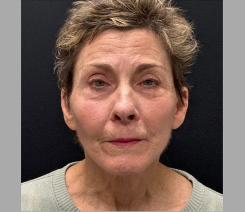 69 year-old-female shown 3 months after full facelift, neck lift, structural facial fat grafting and an Obagi blue TCA peel