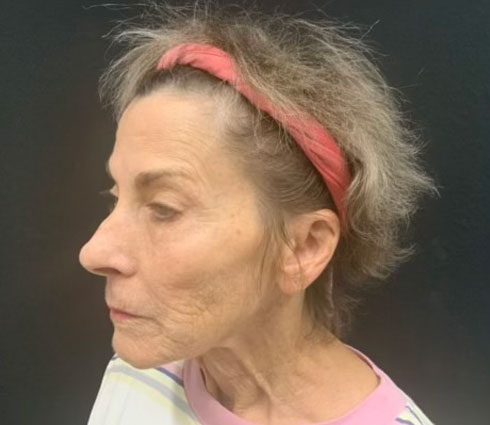 69 year-old-female shown 3 months after full facelift, neck lift, structural facial fat grafting and an Obagi blue TCA peel