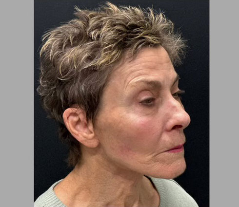 69 year-old-female shown 3 months after full facelift, neck lift, structural facial fat grafting and an Obagi blue TCA peel