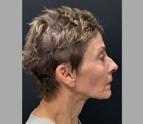 69 year-old-female shown 3 months after full facelift, neck lift, structural facial fat grafting and an Obagi blue TCA peel