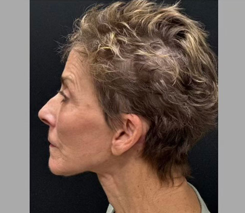 69 year-old-female shown 3 months after full facelift, neck lift, structural facial fat grafting and an Obagi blue TCA peel