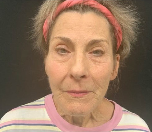 69 year-old-female shown 3 months after full facelift, neck lift, structural facial fat grafting and an Obagi blue TCA peel