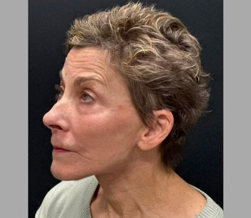 69 year-old-female shown 3 months after full facelift, neck lift, structural facial fat grafting and an Obagi blue TCA peel