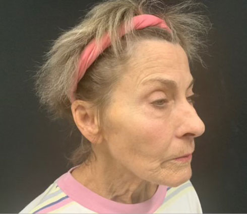 69 year-old-female shown 3 months after full facelift, neck lift, structural facial fat grafting and an Obagi blue TCA peel