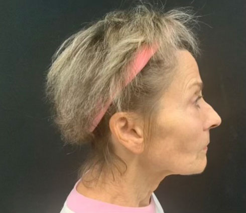 69 year-old-female shown 3 months after full facelift, neck lift, structural facial fat grafting and an Obagi blue TCA peel