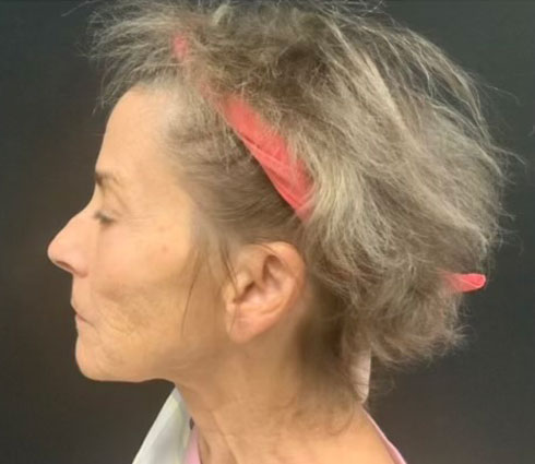 69 year-old-female shown 3 months after full facelift, neck lift, structural facial fat grafting and an Obagi blue TCA peel
