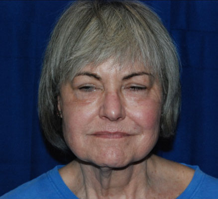 Shown above is a woman in her 60’s about 3 months after undergoing facelift, neck lift, brow lift, upper and lower blepharoplasties, right lower lid festoon resection, upper lip lift and mullerectomies