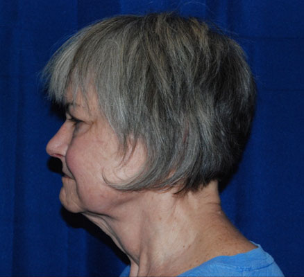 Shown above is a woman in her 60’s about 3 months after undergoing facelift, neck lift, brow lift, upper and lower blepharoplasties, right lower lid festoon resection, upper lip lift and mullerectomies