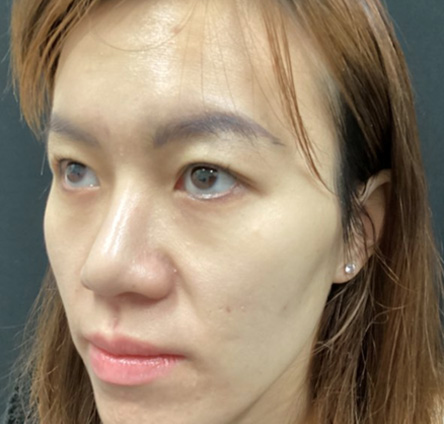 facial fat grafting before and after image