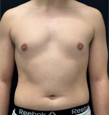 20 year old shown 3 months after bilateral gynecomastia reduction and chest liposuction