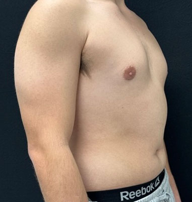 20 year old shown 3 months after bilateral gynecomastia reduction and chest liposuction