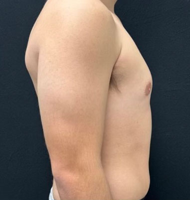 20 year old shown 3 months after bilateral gynecomastia reduction and chest liposuction