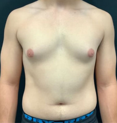 20 year old shown 3 months after bilateral gynecomastia reduction and chest liposuction