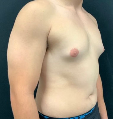 20 year old shown 3 months after bilateral gynecomastia reduction and chest liposuction