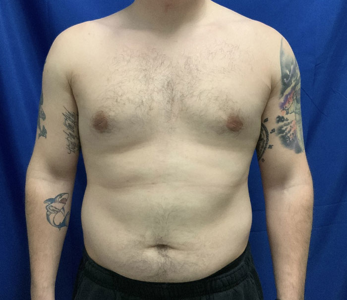 Young man in his early 20s shown 3 months after gynecomastia excision and chest liposuction.