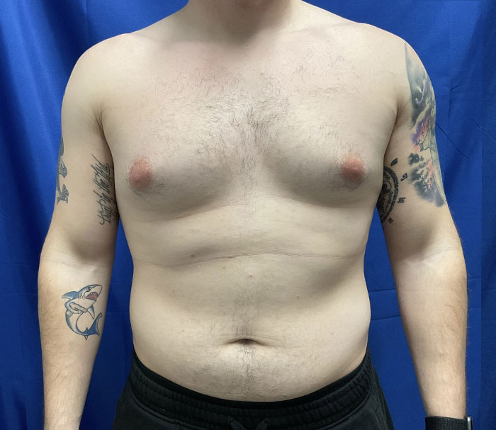 Young man in his early 20s shown 3 months after gynecomastia excision and chest liposuction.