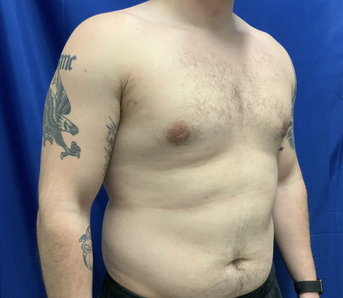 Young man in his early 20s shown 3 months after gynecomastia excision and chest liposuction.