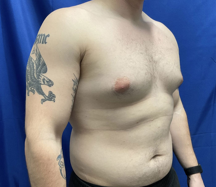 Young man in his early 20s shown 3 months after gynecomastia excision and chest liposuction.