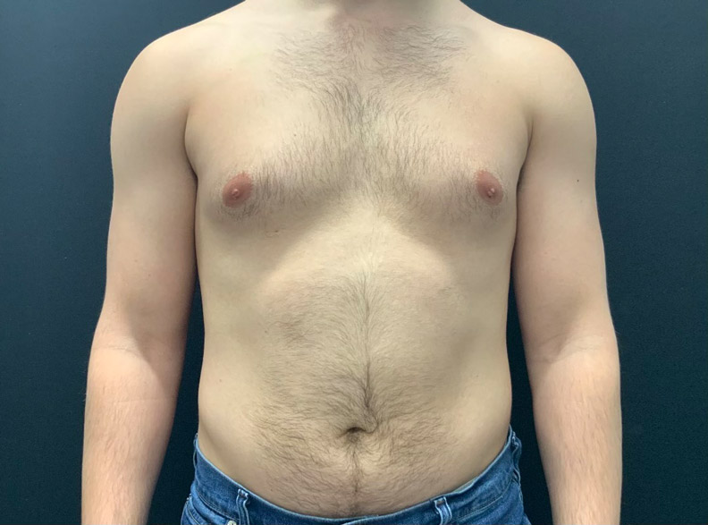 24 year old male shown 3 months after excision of bilateral gynecomastia and chest liposuction